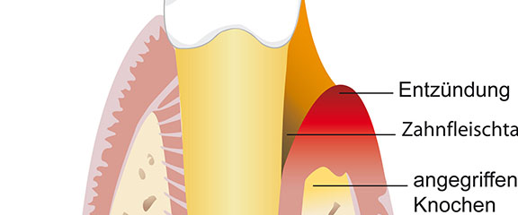 Parodontitisbehandlung